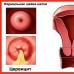 Cervicite: descrizione, sintomi, diagnosi, trattamento Cervicite batterica
