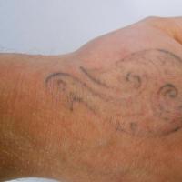 Penghapusan tato di rumah - apakah mungkin untuk mengurangi tato sendiri?